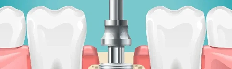 The Complete Guide to Understanding Modern Dental Implants