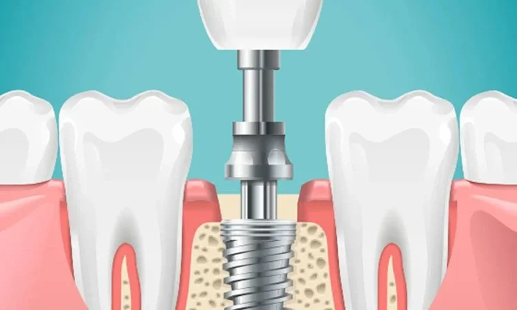 The Complete Guide to Understanding Modern Dental Implants