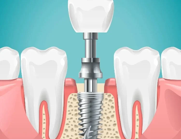 The Complete Guide to Understanding Modern Dental Implants