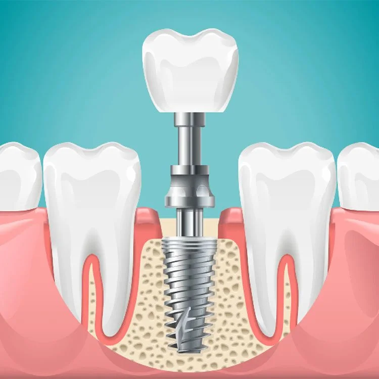 The Complete Guide to Understanding Modern Dental Implants